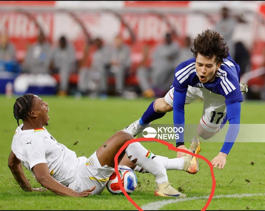 SannieDaara's tweet image. 🇬🇭💔 Update: Francis Abu undergoes successful surgery in Japan

After that horrific clash in the Ghana vs Japan game left Francis Abu with fractures in two bones, the midfielder has successfully undergone surgery in Japan. 🙏🏾❤️

Huge credit to Dr. Prince Pambo, the Black Stars…