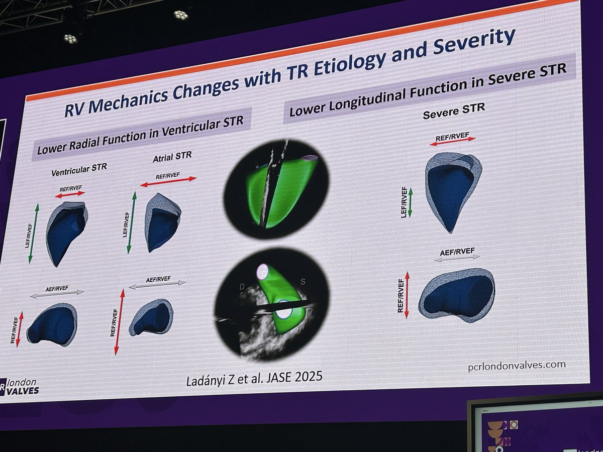 Sticchi_Alex's tweet image. Amazing talk by Prof @denisamuraru showing the cutting edge of the knowledge on #right #ventricle function assessment in the #Tricuspid #Regurgitation scenario!
We need an effective parameter!!
#PCRLV @luigibadano @hahn_rt @FabienPraz @PCRonline