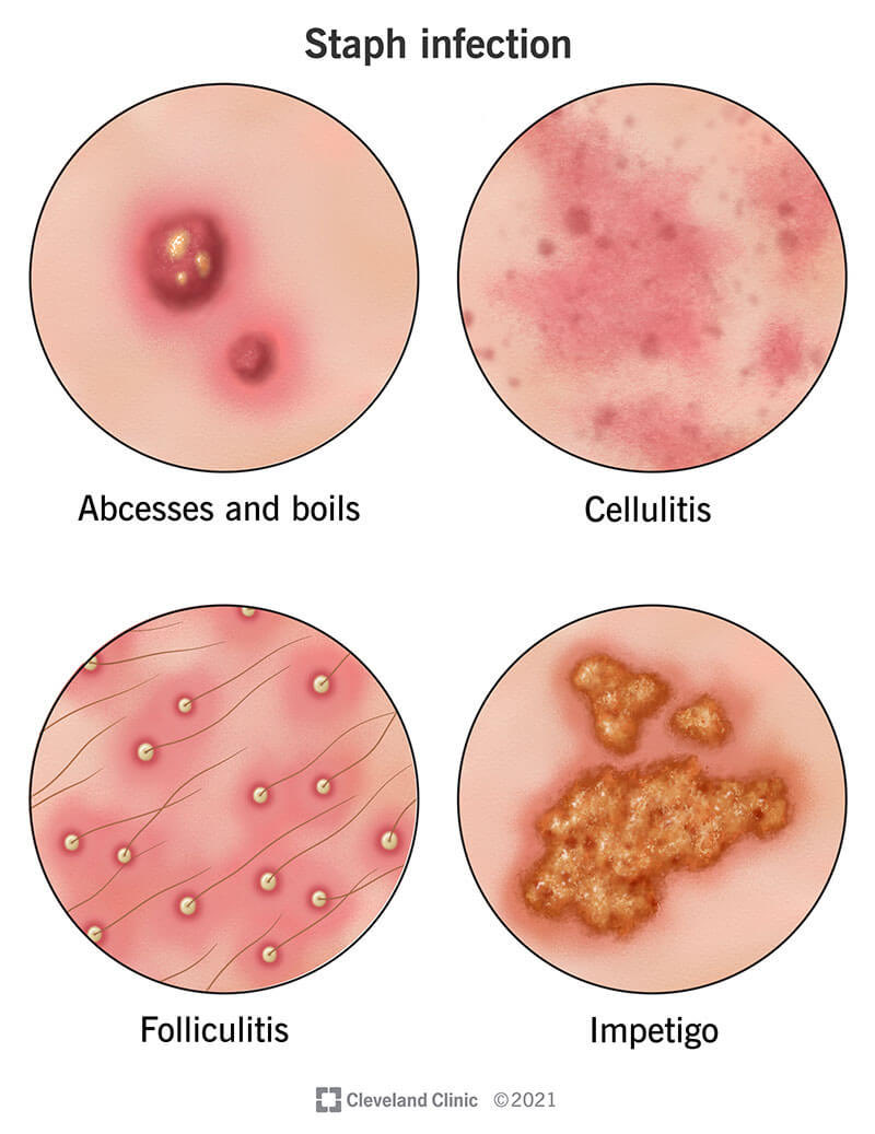 oladapo1805's tweet image. STAPHYLOCOCCUS SP.

Many people who talk about Staphylococcus do not know what it is. Stop listening to quacks and read this:

Check my comments below 👇🏾