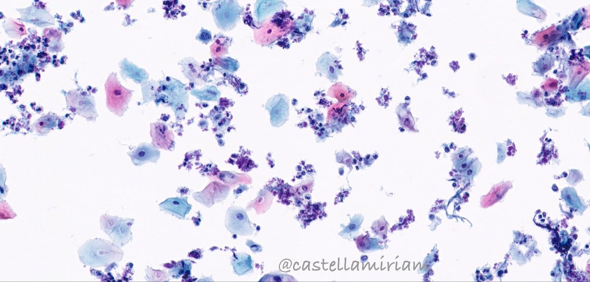 castellamiriam's tweet image. Tricomonas
💡En frotis muy inflamatorios, con vaginosis bacteriana o gardnerella, debes pensar en ellas
💡De forma aislada, pero en CBL más frecuentemente por encima de las células
💡Pequeñas, forma de almendra, citoplasma grisáceo, núcleo central alargado de color gris oscuro.