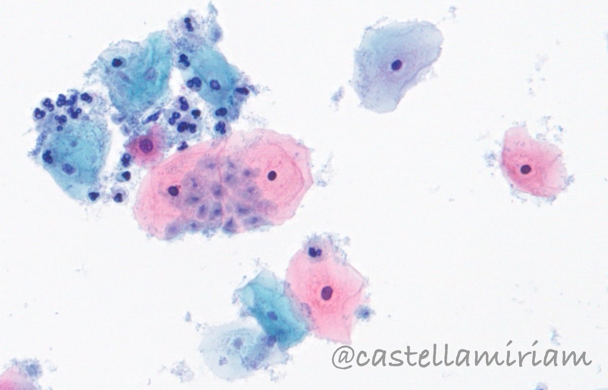castellamiriam's tweet image. Tricomonas
💡En frotis muy inflamatorios, con vaginosis bacteriana o gardnerella, debes pensar en ellas
💡De forma aislada, pero en CBL más frecuentemente por encima de las células
💡Pequeñas, forma de almendra, citoplasma grisáceo, núcleo central alargado de color gris oscuro.