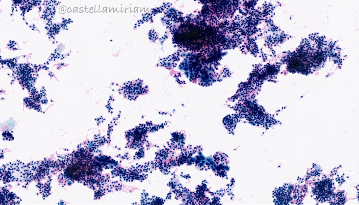 castellamiriam's tweet image. Tricomonas
💡En frotis muy inflamatorios, con vaginosis bacteriana o gardnerella, debes pensar en ellas
💡De forma aislada, pero en CBL más frecuentemente por encima de las células
💡Pequeñas, forma de almendra, citoplasma grisáceo, núcleo central alargado de color gris oscuro.