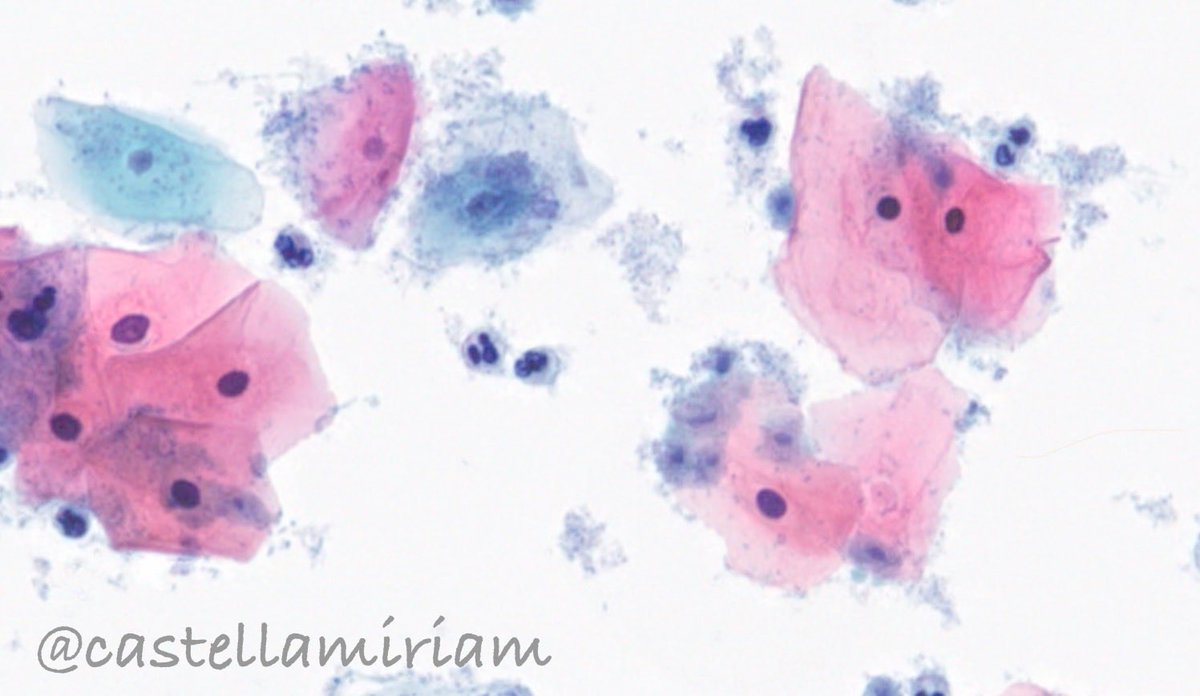 castellamiriam's tweet image. Tricomonas
💡En frotis muy inflamatorios, con vaginosis bacteriana o gardnerella, debes pensar en ellas
💡De forma aislada, pero en CBL más frecuentemente por encima de las células
💡Pequeñas, forma de almendra, citoplasma grisáceo, núcleo central alargado de color gris oscuro.