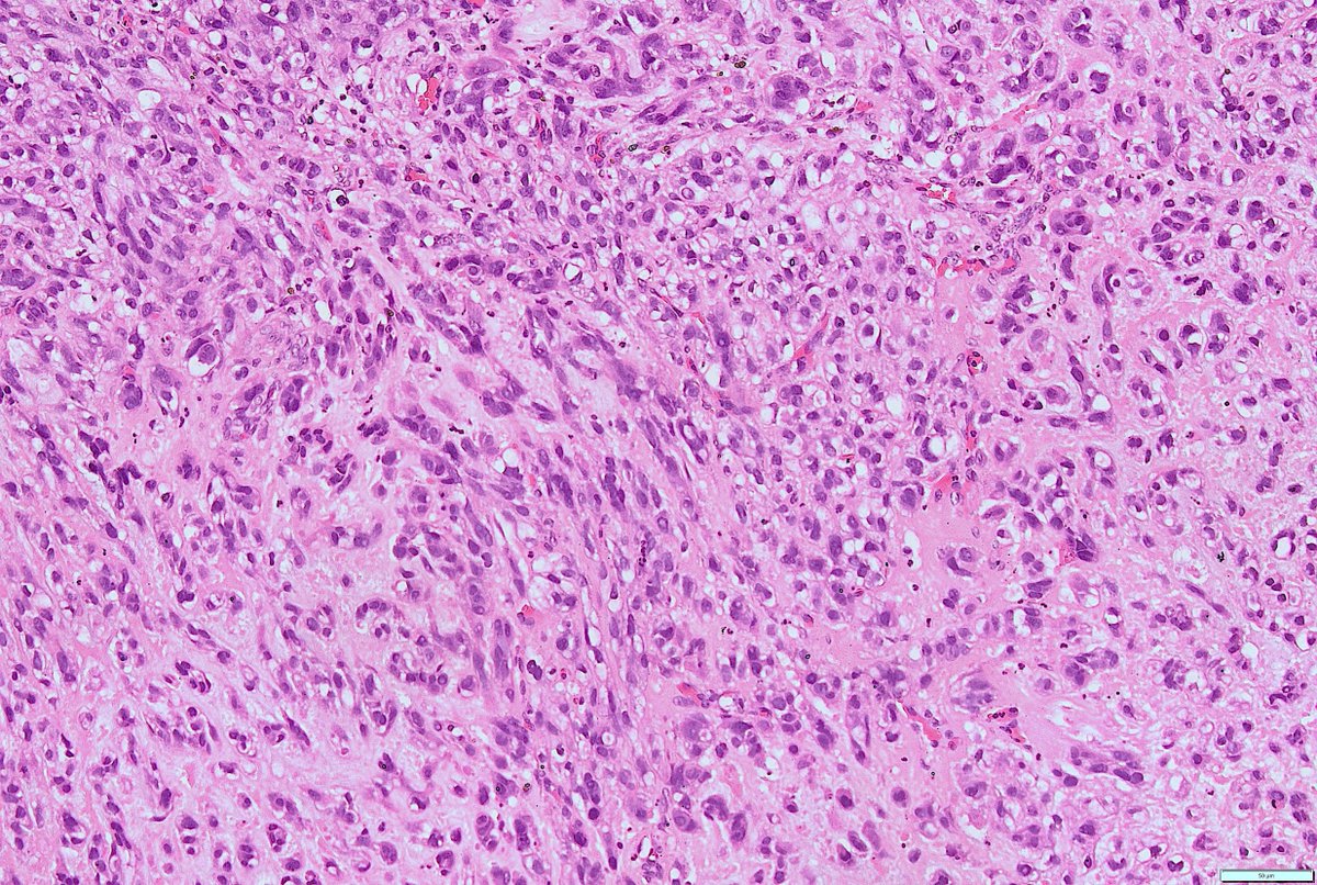 SumantaDas_7's tweet photo. 1/23   Adult male. Clivus lesion. #PathX #PathTwitter #PathClassic #BSTPath #NeuroPath
#PathClassic followed by #PathTweetorial, with a compilation of cases from #PathX #PathTwitter by colleagues https://t.co/cRu4XIekdk