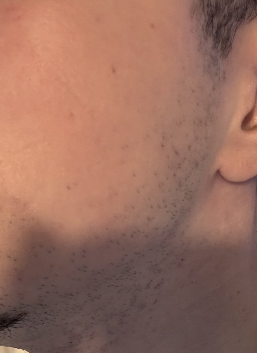 deezpic's tweet photo. @99theo_ @JulienDoo @Orttheus Enft je pensais surtout aux petits pouls de merde comme ça qui poussent après 2 jours de rasage😭😭 ni le one blade ni mon rasoir gilette sensitive skin les font partir😔😔 https://t.co/TdvAX3AbEa