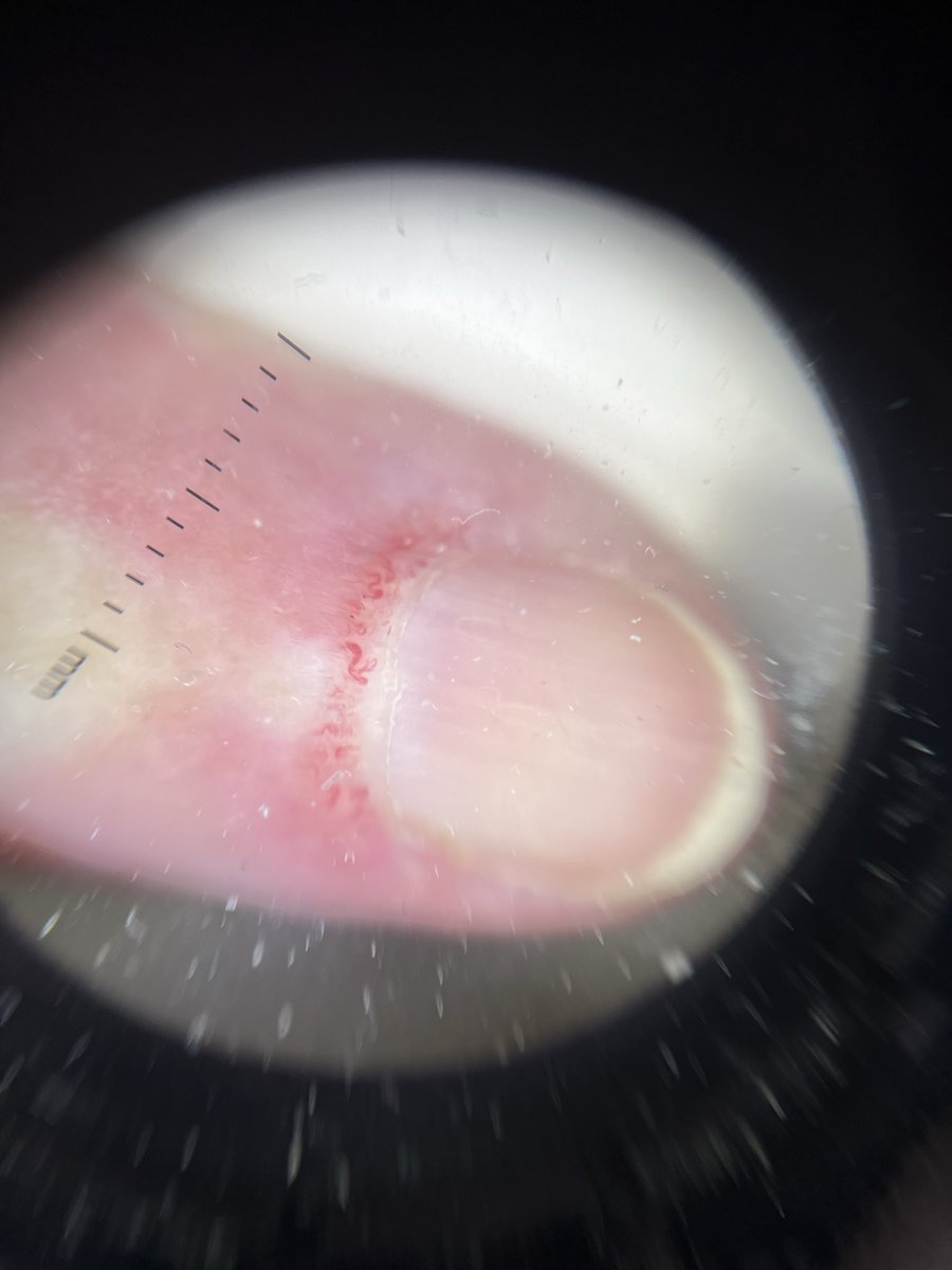 76 a. 👵🏻, ama de casa, nos dice que “no se puede poner cremas desde hace semanas porque todas le dan alergia en los párpados”.
Además, se nota más cansada últimamente y en la analítica le ha salido “algo de anemia”. 
Nosotros, curiosones como siempre, le miramos las uñas… 🔎