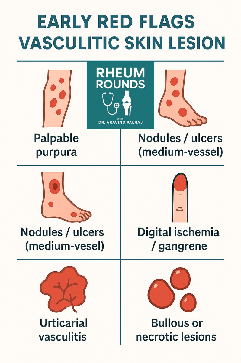 Not all skin rashes are innocent.
Purpura, livedo, ischemic fingertips, necrotic blisters — the skin often reveals vasculitis before anything else.
Spot the pattern early.

#DermTwitter #RheumTwitter #MedTwitter <a href="/DrAkhilX/">Dr. Akhil 🇮🇳</a> <a href="/IhabFathiSulima/">Dr Ihab Suliman</a> <a href="/DrNikhilMD/">Dr. Nikhil Agrawal</a>