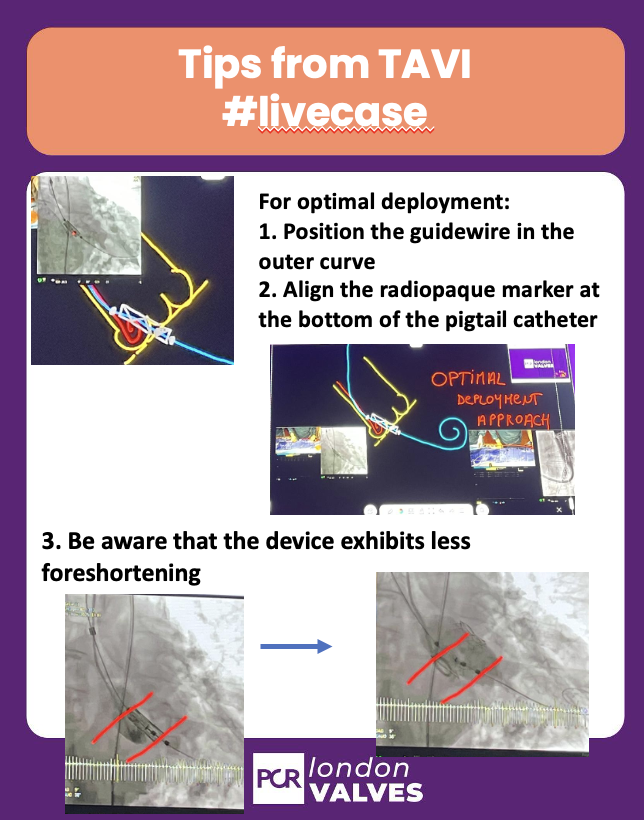 TagliariPaula's tweet photo. Tips from @RodrigoEstvez1 #TAVI #LiveCase at #PCRLV:
For optimal THV deployment: ↩️
1. Position the guidewire in the outer curve
2. Align the radiopaque marker 🎯 at the bottom of the pigtail catheter
3. Be aware that this last generation device exhibits less foreshortening
@PCRonline @PamelaGatto @alcantaramonica
@dr_chrisallen @O_Azizy_MD @BenekiEirini @MiChen__
@CurioJonathan @juliendreyfus1 @jcecharte @DrGarot @cvnurselin @Omar_A_Oliva @drtsakamoto
@a_sorropago @m_taramasso @dr_tyxiong