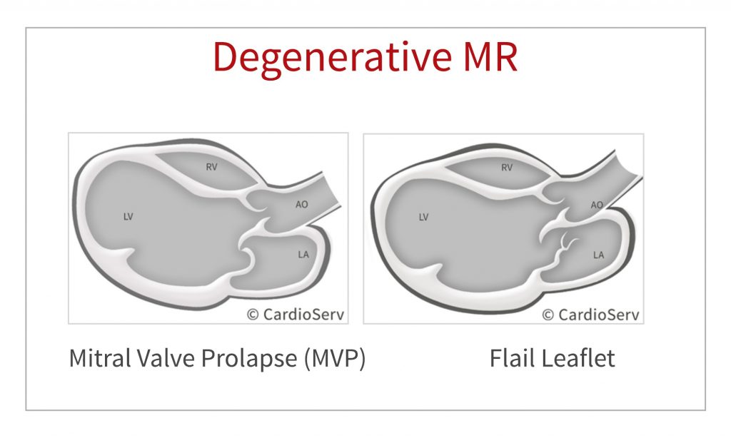 Ahmedata7777's tweet photo. Mitral valve Billowing vs Prolapse vs Flail 

Billowing: Leaflet BODY displaced below mitral annular level.

Prolapse: Leaflet TIP displaced below mitral annular level with TIP toward LV.

Flail: Leaflet TIP displaced below mitral annular level with TIP toward LA.

Billowing >>> BODY
Prolapse >>> TIP & Toward LV
Flail >>> TIP & Toward LA