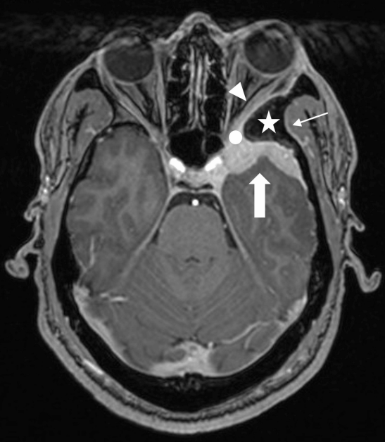 DocNavarrow's tweet photo. 👨‍🚀A 34-year-old man presents with years of retro-orbital headache, mild proptosis, and new-onset blurred vision. An extra-axial spheno-orbital mass with associated bone changes leads to a presumed diagnosis, but pathology reveal something different. 

What is your diagnosis? https://t.co/W9fNP1lzc2