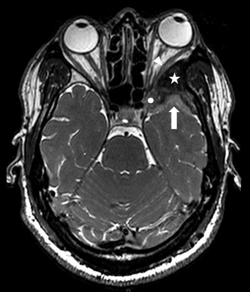 DocNavarrow's tweet photo. 👨‍🚀A 34-year-old man presents with years of retro-orbital headache, mild proptosis, and new-onset blurred vision. An extra-axial spheno-orbital mass with associated bone changes leads to a presumed diagnosis, but pathology reveal something different. 

What is your diagnosis? https://t.co/W9fNP1lzc2