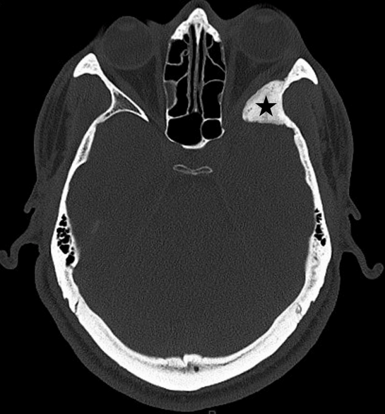 DocNavarrow's tweet photo. 👨‍🚀A 34-year-old man presents with years of retro-orbital headache, mild proptosis, and new-onset blurred vision. An extra-axial spheno-orbital mass with associated bone changes leads to a presumed diagnosis, but pathology reveal something different. 

What is your diagnosis? https://t.co/W9fNP1lzc2