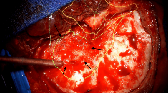 DocNavarrow's tweet photo. 👨‍🚀A 34-year-old man presents with years of retro-orbital headache, mild proptosis, and new-onset blurred vision. An extra-axial spheno-orbital mass with associated bone changes leads to a presumed diagnosis, but pathology reveal something different. 

What is your diagnosis? https://t.co/W9fNP1lzc2