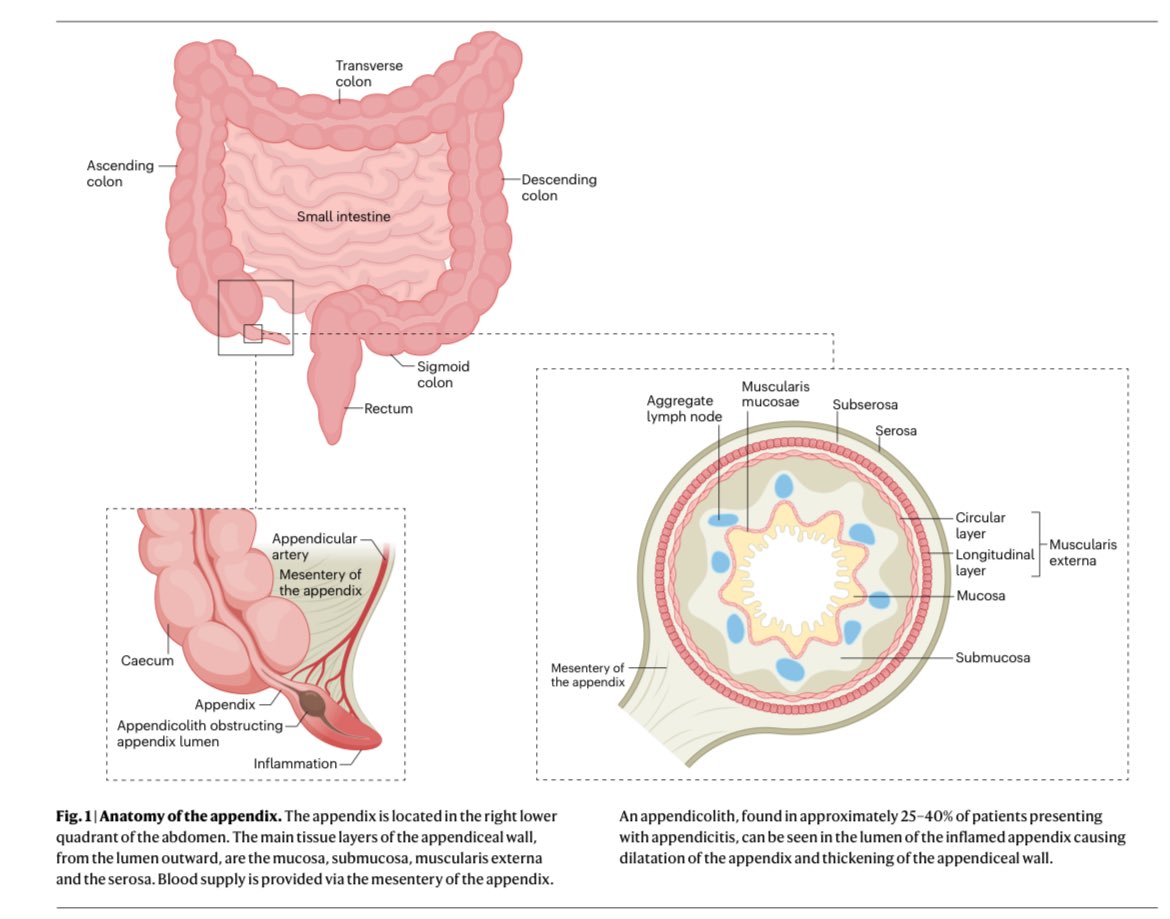 AliSMV7's tweet photo. 🔺Appendicitis (Nature 2025)

 https://t.co/CSjgmulpmC https://t.co/TqOGWaHmY0