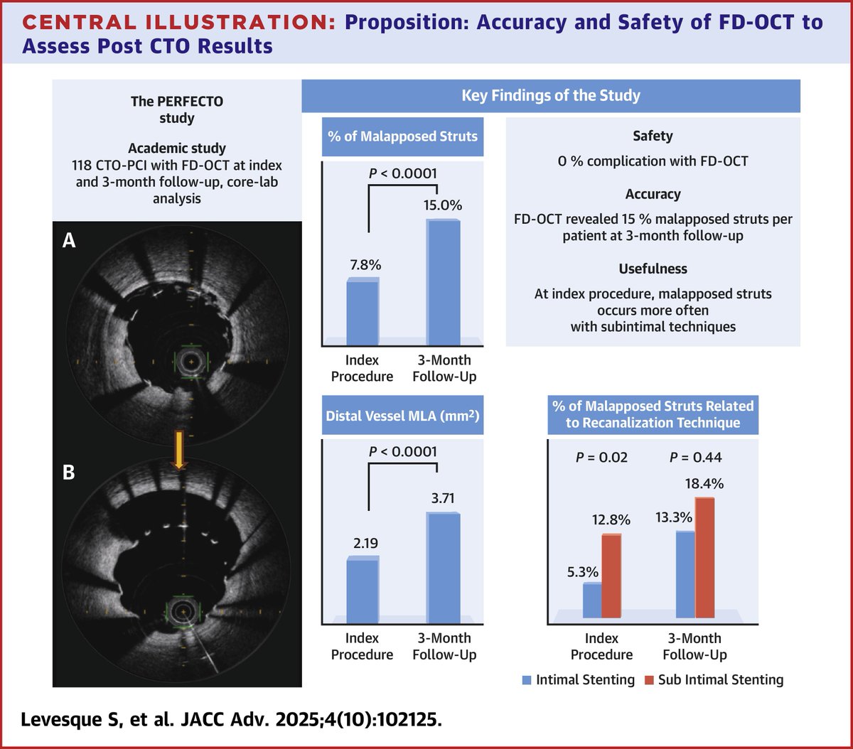 JACCJournals's tweet image. CTO-PCI could affect stent healing with a high incidence of immediate and late-acquired malapposition. These results support the interest of using FD-OCT during follow-up to better assess #CTO recanalization results. jacc.org/doi/10.1016/j.… #JACCAdvances #PCI