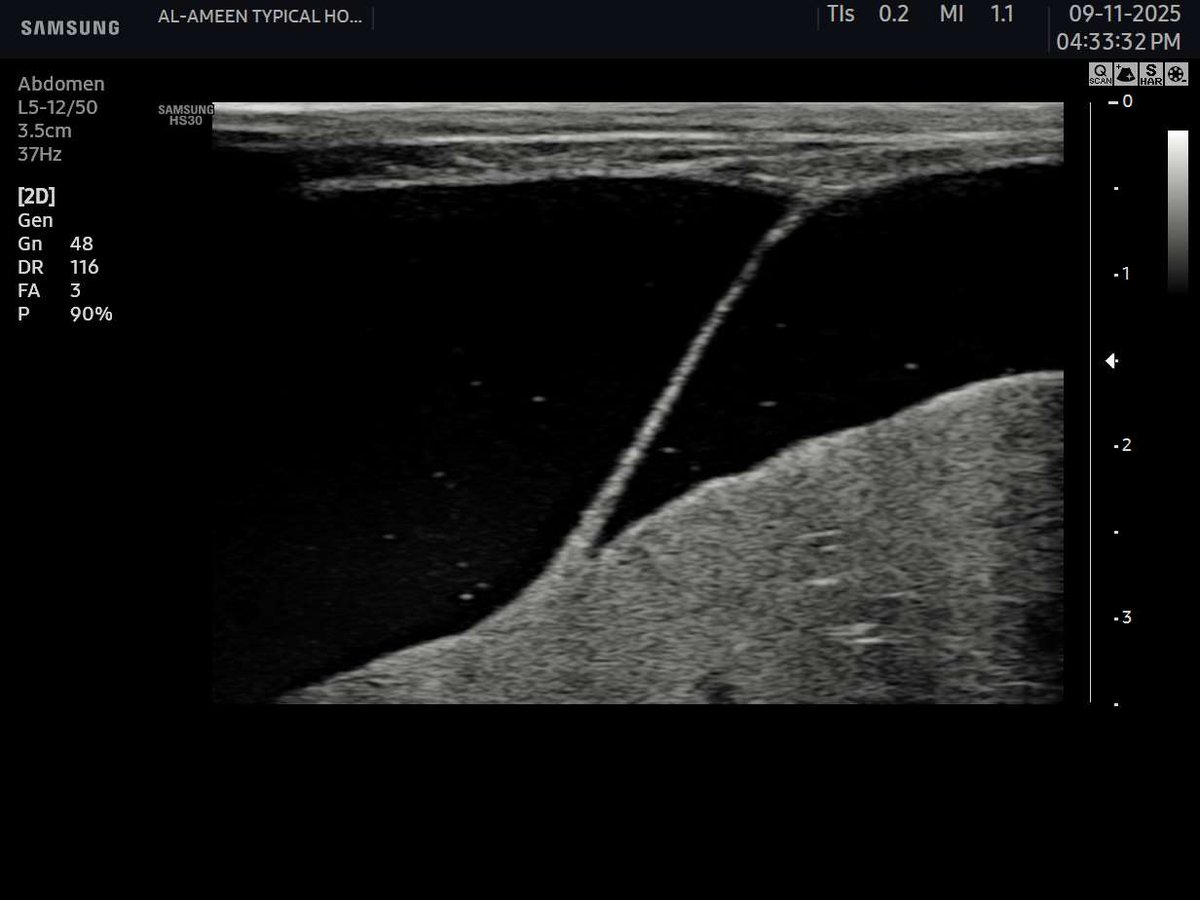EchoTech_4's tweet image. ligamentus teres hepatis 
(formed after obliteration of the fetal umbilical vein)

#EchoTech #Ultrasound