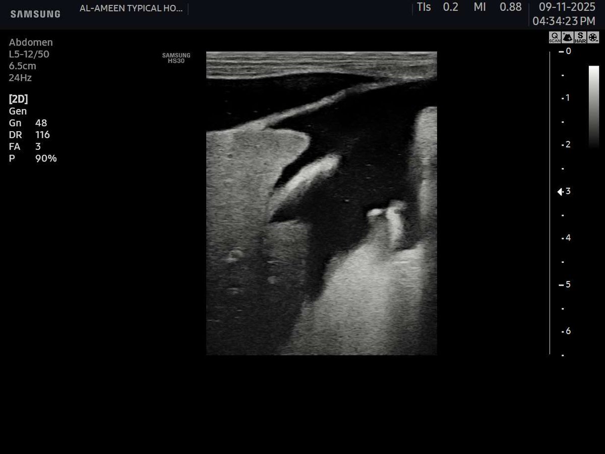EchoTech_4's tweet image. ligamentus teres hepatis 
(formed after obliteration of the fetal umbilical vein)

#EchoTech #Ultrasound