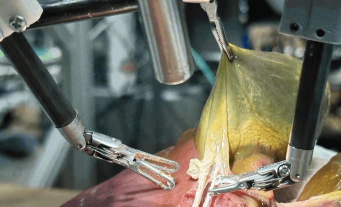 Roba_Labs's tweet image. The future of cancer surgery is here.

AI-powered surgical robots are transforming care:

- 10× magnified 3D vision
- Tremor-free precision
- Safer, minimally invasive procedures