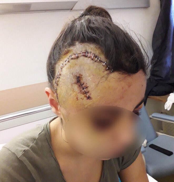 Brevesdepresse's tweet image. 🔴🇫🇷INFO -L’enquête pour identifier les policiers qui ont fracassé le crâne d’une femme à #Marseille s’accélère. Des agents ont reconnu avoir été présents. L’un d’eux dénonce les pressions de sa hiérarchie et du syndicat Alliance pour couvrir ses collègues.mediapart.fr/journal/france…