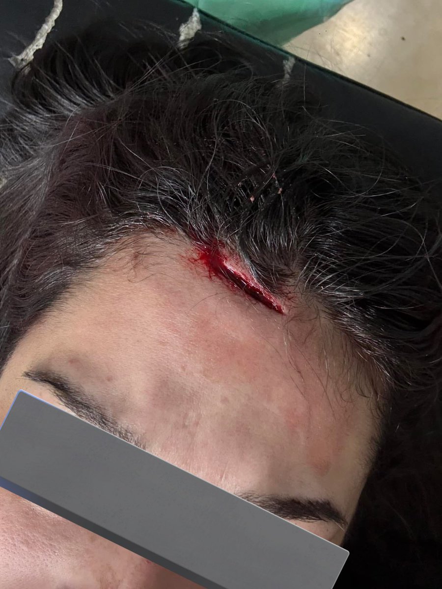 La víctima no fue auxiliada ni por el personal del Bar Bambú Manacar ni por la Secretaría de Seguridad Ciudadana (SSC), con ayuda de sus amigos se trasladó a un hospital e inició la denuncia por los hechos. #CdMx
