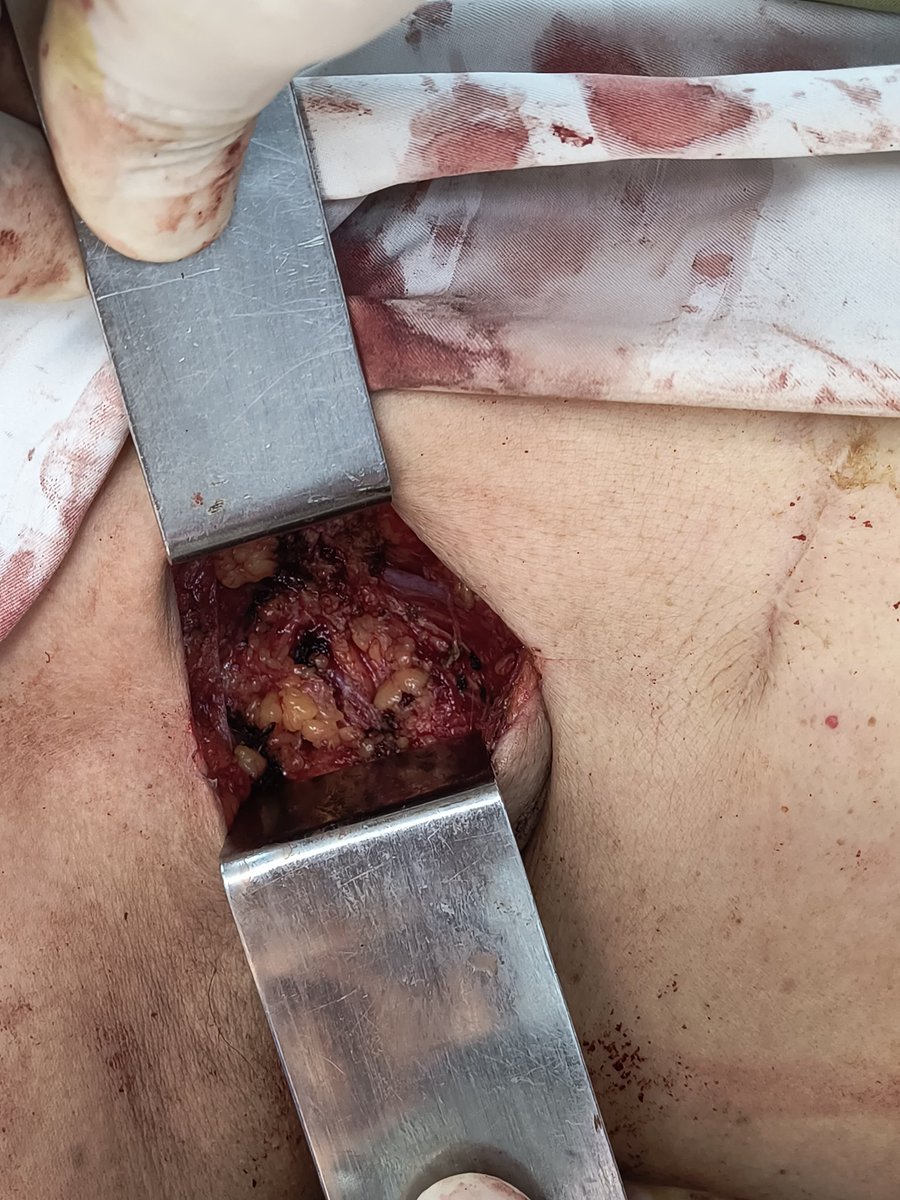 Paciente con un cancer de mama que concurre por una adenomegalia axilar de mas de 5 cm que le estaba bloqueando la axilar. 
Le traía edema y dolor 
Con el oncologo, lo que buscábamos era conocer el tipo histologico 
Si había mutado del cáncer original