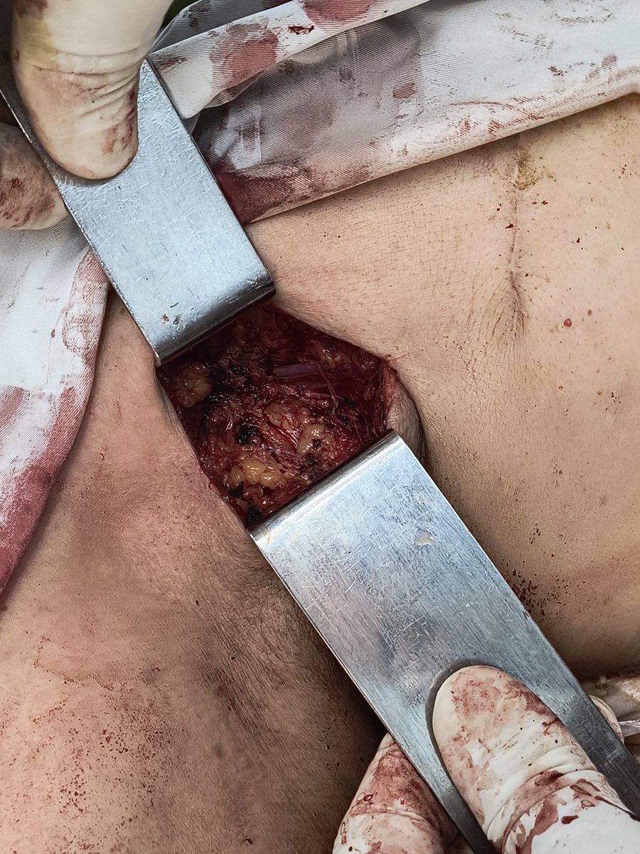 2/2
Me pregunte si no era mejor una punción diagnóstico y cambio de esquema de quimioterapia
hay algo que tener en cuenta siempre es el confort de la paciente y sobretodo calidad de vida. Estaba dolorida y no hay nada mejor para un cirujano y mejorarle la vida a nuestra