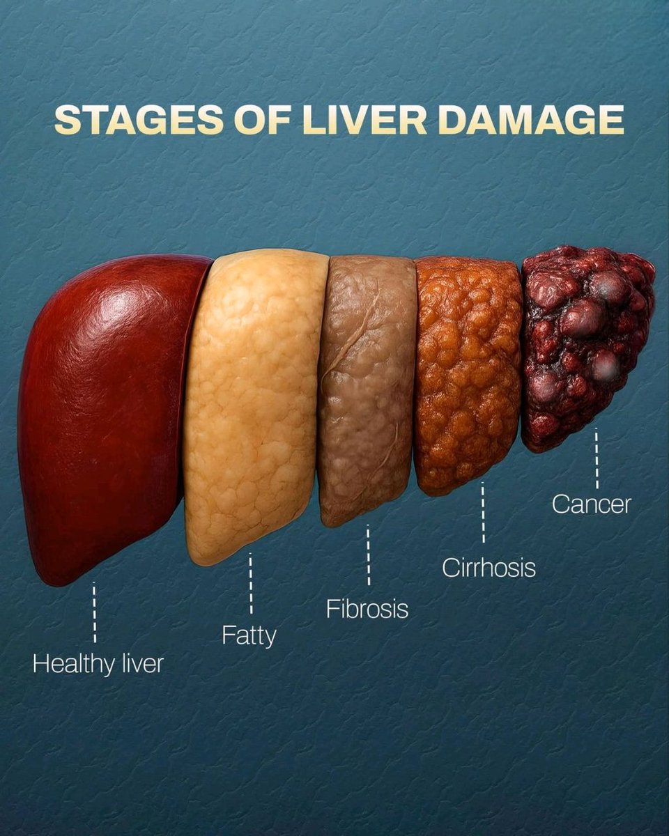 andrewjohnpub1's tweet image. Liver damage can progress through various stages, starting with inflammation, leading to fibrosis, and eventually resulting in cirrhosis. Symptoms may include fatigue, jaundice, and abdominal pain. Early detection and treatment are crucial! #LiverHealth 💛⚠️