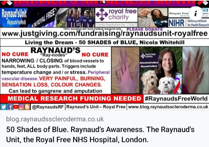 RaynaudsRf's tweet image. blog.raynaudsscleroderma.co.uk/2018/10/raynau… 
50 shades of blue 🥶 Hibernation weather ❄️ 
#SclerodermaFreeWorld #RaynaudsFreeWorld #Research #Scleroderma #SystemicSclerosis #Raynauds #Autoimmune #RareDisease #NoCure #UnknownCause #LifeChanging #ConnectiveTissue #BePartOfResearch #Bluefingers