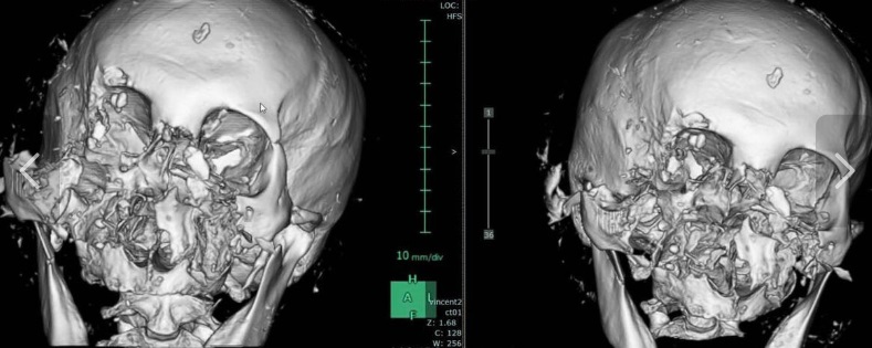 『インフルエンザ脳症で亡くなる子は10人くらい』

コレは『クマで亡くなった人は10人くらい』とおんなじです

『亡くなってない=五体満足』という意味ではありません