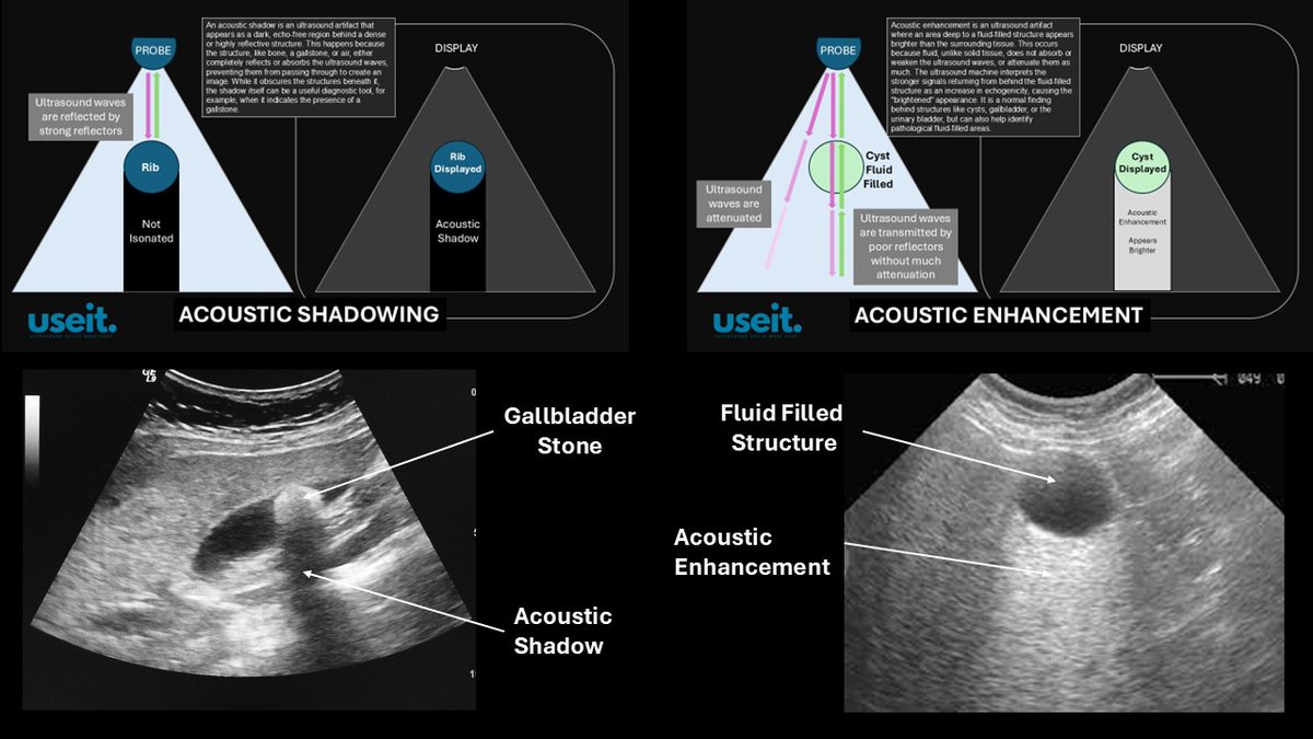 pocus_today's tweet image. Acoustic Shadow and Acoustic Enhancement
#POCUS #useit