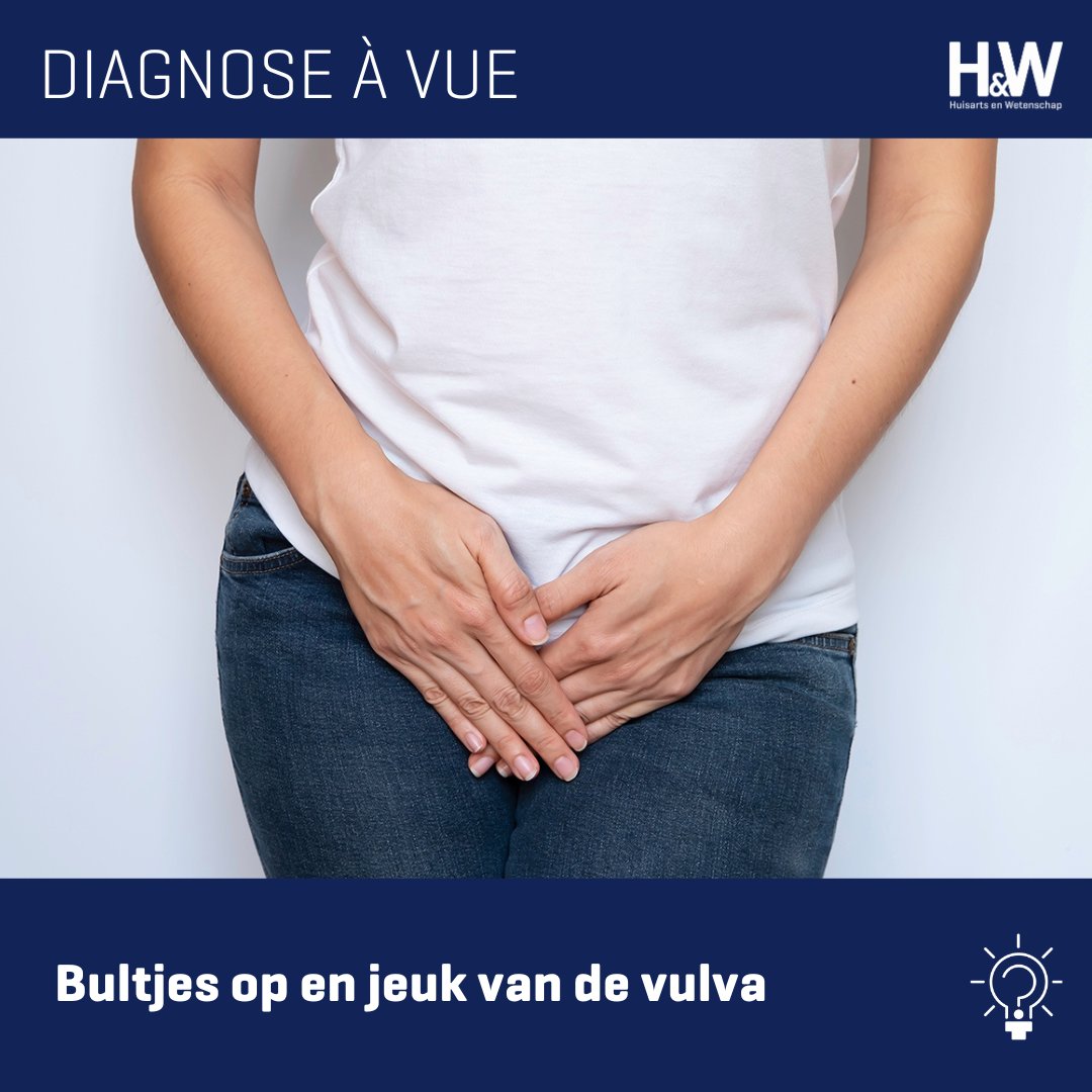 Een vrouw meldt zich op het spreekuur met jeuk in de schaamstreek en vulva. Ze heeft huidkleurige bultjes aan beide zijden van de schaamlippen. Wat is je diagnose?

ow.ly/ZwFM50XpOh6

#huisartsenzorg #jeuk #vulva #bultjes #diagnose