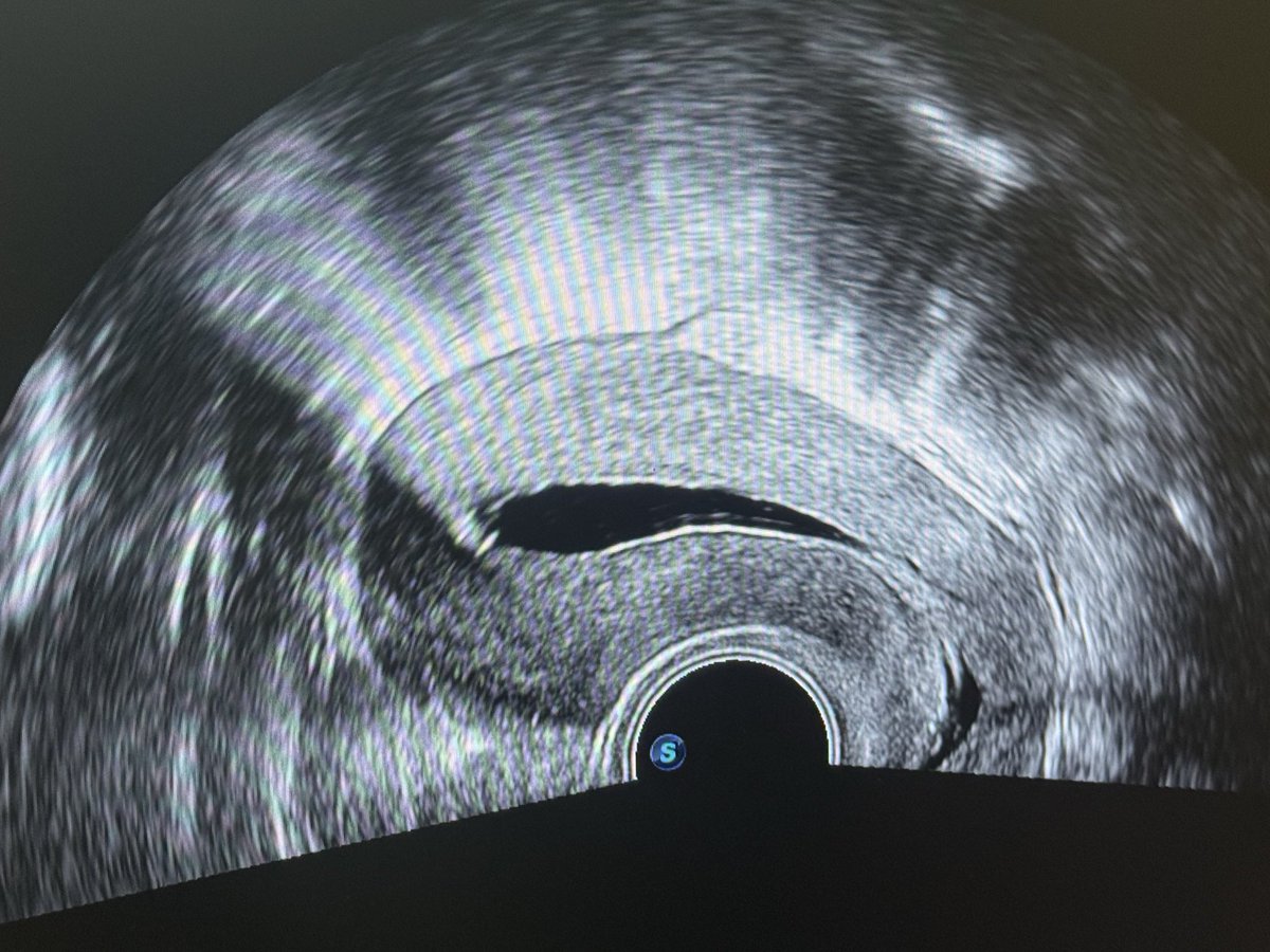 dr_pariissa's tweet image. سونوگرافی SIS که با تزریق مایع درون حفره رحم، وضعیت حفره رحم را نشان میدهد.این سونوگرافی کاملا نرمال و طبیعه.
#SIS