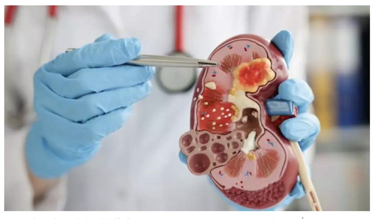 🧐Uno de los problemas de la enfermedad renal crónica es que una persona puede perder hasta el 90% de la función renal antes de experimentar cualquier tipo de síntomas. Los RIÑONES los grandes olvidados
📰Noticia completa en <a href="/elperiodico/">El Periódico</a>  elperiodico.com/es/salud/20251… 
Incluye