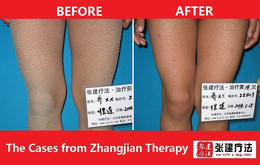 ZJTherapy's tweet image. 🤗Ichthyosis treatment 

X-linked ichthyosis for 14 times treatment

🤝If you want to know more about your skin, see successful ichthyosis treatment cases and skin care tips, please contact us to send you ichthyosis book. 
☎️Contact us: wa.me/message/A6E3X3…
 #Ichthyosis