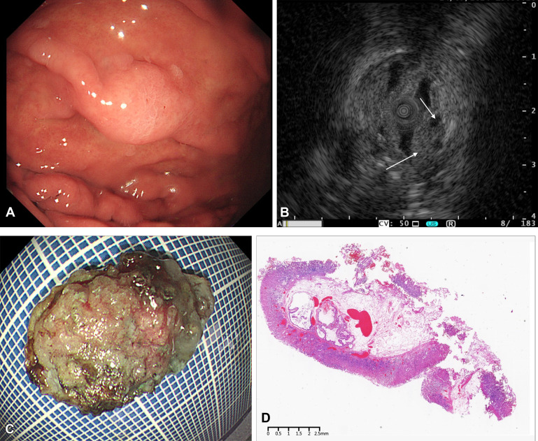 GIE_Journal's tweet image. At the Focal Point, Sun et al find an &quot;Unusual submucosal mass with cystic features revealed by EUS: a case of gastric adenocarcinoma of the fundic gland type.&quot; giejournal.org/article/S0016-…

#GITwitter