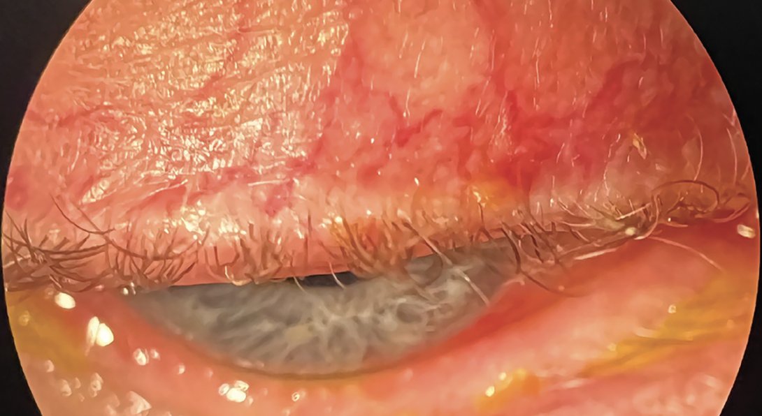revoptom's tweet image. Ocular Rosacea: How to Recognize and React

From subtle vascular changes to sight-threatening complications, this underdiagnosed condition requires careful assessment and individualized care.
reviewofoptometry.com/article/ocular…
#atropine #optometry #eyecare