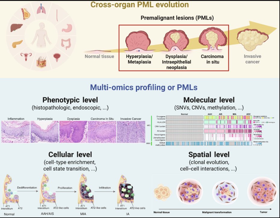 EdEsplin's tweet photo. "...the convergence of high-resolution #multiomics with sophisticated #AI is poised to redefine #premalignant lesion research, enabling #pancancer exceedingly-#early risk stratification and pharmacological #prevention."

For example, #multiomics analysis of #colorectal #polyps from #patients w/ #familialadenomatouspolyposis/#FAP found that the #arachidonicacid pathway was up-regulated early in hyperplasia, which was targeted by #aspirin, giving a potential explanation of the preventative #treatment mechanism. @EdEsplin et al. https://t.co/hAEJsMOr4A @NatureCancer 

#genetics #genomics #RNASeq #proteomics #metabolomics #lipidomics #CRC #colorectalcancer #precisionmedicine #precisiontherapy #clinicaltrials #precisionprevention @CGAIGC 

https://t.co/hxjR7vX83T #FeiranZhang et al. #Research @ScienceMagazine