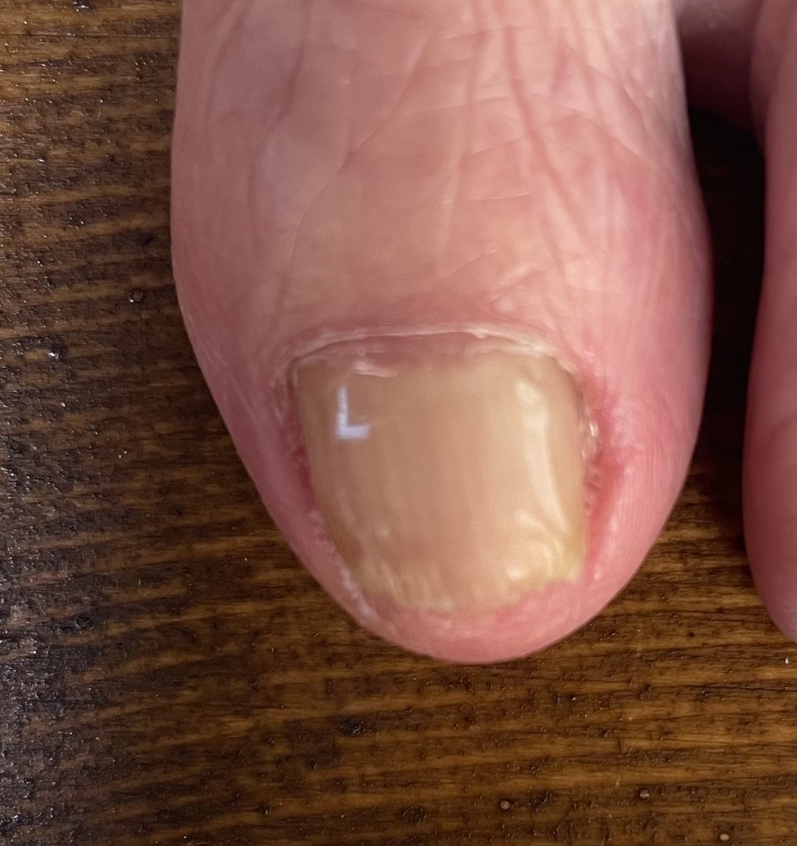 hiro_chiryo_asi's tweet image. 目立たない巻き爪ケア　#HeySwitch 

#LifeOTC
#StepCraft
#NWPL
#csソックス 
#巻き爪
#シューズ選びアドバイス
#井原市
#足を元気にする治療院

asi-hiro-chiryo.jimdofree.com/%E5%B7%BB%E3%8…