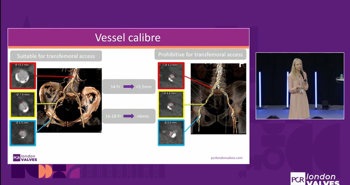 Zill_cardio's tweet image. Role of preprocedural CT in assessment &amp;amp; management of access site complications in patient undergoing transfemoral TAVI 

Preprocedural CT helps to assess :

Vessel Caliber 
Vessel Tortuousity
Distribution of Ca
Optimal puncture site 
Alternative Access 

#TAVR #Imagefirst #1/3