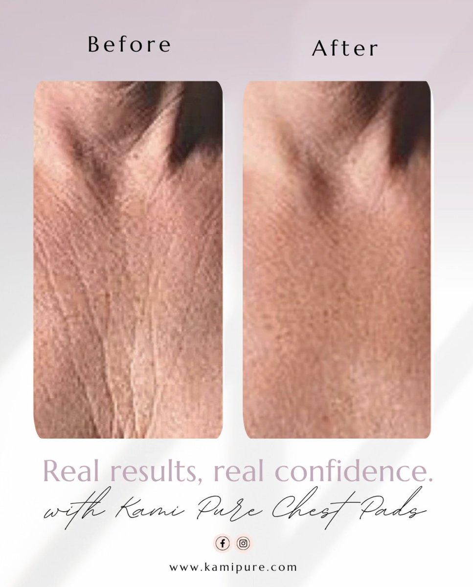 thekamipad's tweet photo. Real results, real confidence. This before-and-after shows how Kami Pure Chest Pads help smooth wrinkles caused by sun exposure, side sleeping, and loss of elasticity.

. https://t.co/5Bfcglc2lO