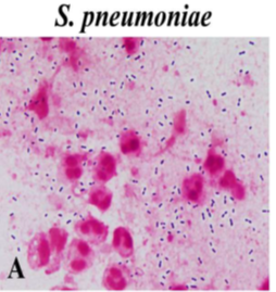 Esta semana comenzamos la segunda asignatura del Máster “Infecciones adquiridas en la Comunidad”, asignatura esencial para la práctica clínica. Se analizarán los principales síndromes, manejo clínico y estrategias de prevención.