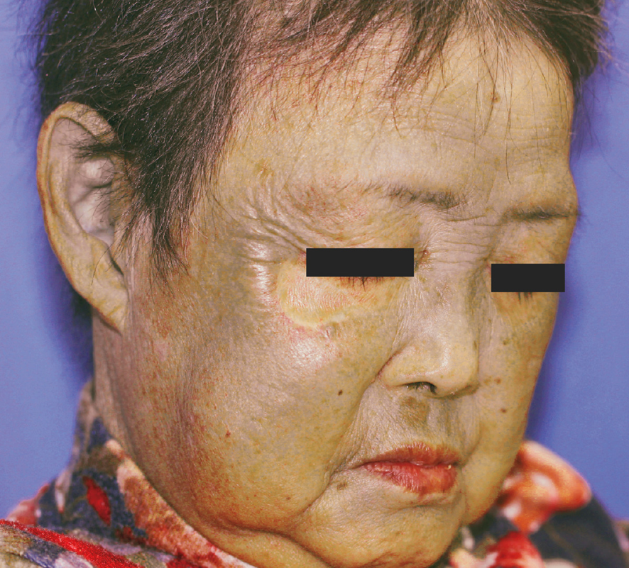 guerreroespejo's tweet image. 75 años♀️, 4 años de minociclina para osteomielitis crónica: oscurecimiento de piel en rostro durante 3 años, hiperpigmentación azul-grisácea en cara y orejas, respetando la zona debajo del👁️ dcho, donde se realizó injerto de piel 6 años antes
1/2
DOI: 10.1056/NEJMicm2111130
#IDX