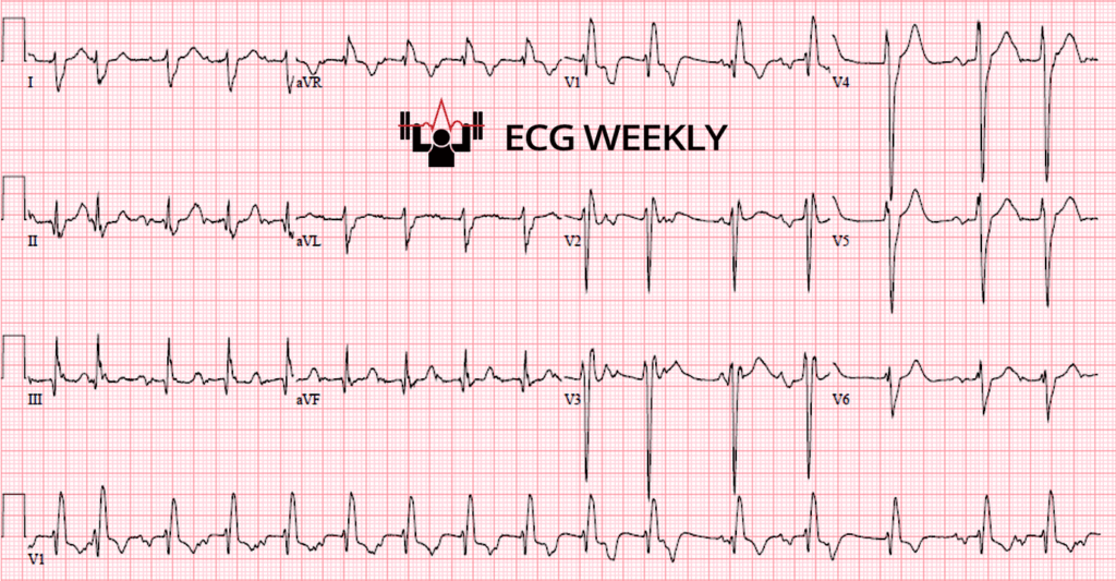 A 73-year-old man presents to the emergency department with nausea and vomiting. The following ECG was obtained on arrival and interpreted by the computer as “sinus tachycardia”, but something important was missed......ecgweekly.com/weekly-workout…
