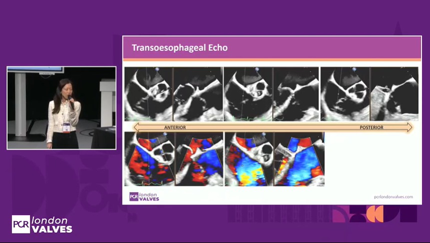 Zill_cardio's tweet image. #HappeningNow at #PCRLV

Simulation based learning on optimal procedural techniques in Tricuspid TEER 

#T_TER @PCRonline @APSIC6