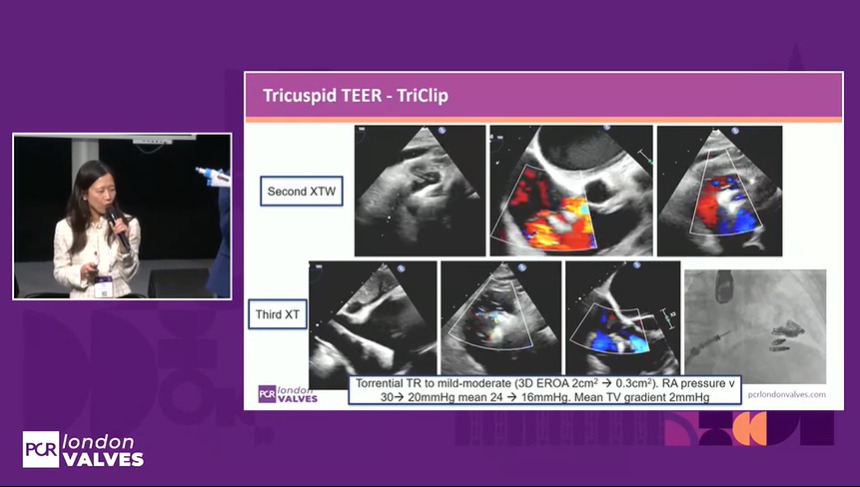 Zill_cardio's tweet image. #HappeningNow at #PCRLV

Simulation based learning on optimal procedural techniques in Tricuspid TEER 

#T_TER @PCRonline @APSIC6