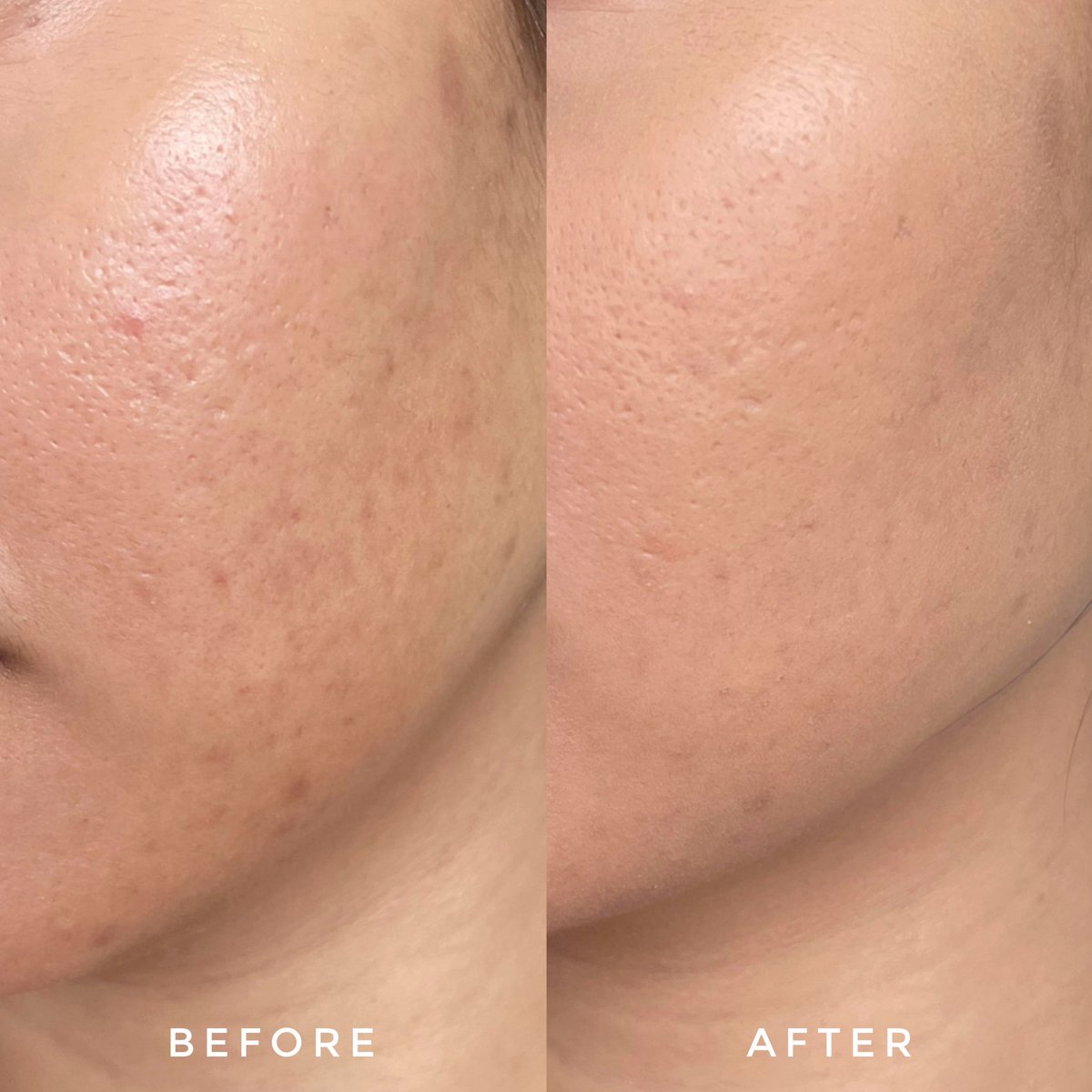 แป้ง Skintific สี 04N Natural Beige สีเข้มสุด ปกติเข้มกว่าผิวไปนิด ค่อยเก็บไว้ใช้ช่วงที่ผิวเข้มบ่มแดดกว่านี้หน่อย ปกปิดค่อนข้างดี ขนาดไม่ได้ย้ำอะไรก็กลบรอยดำที่ไม่เข้มมากได้เลย ไม่หยา เนื้อบางเบาดี เบลอรูขุมขนโอเค🫶