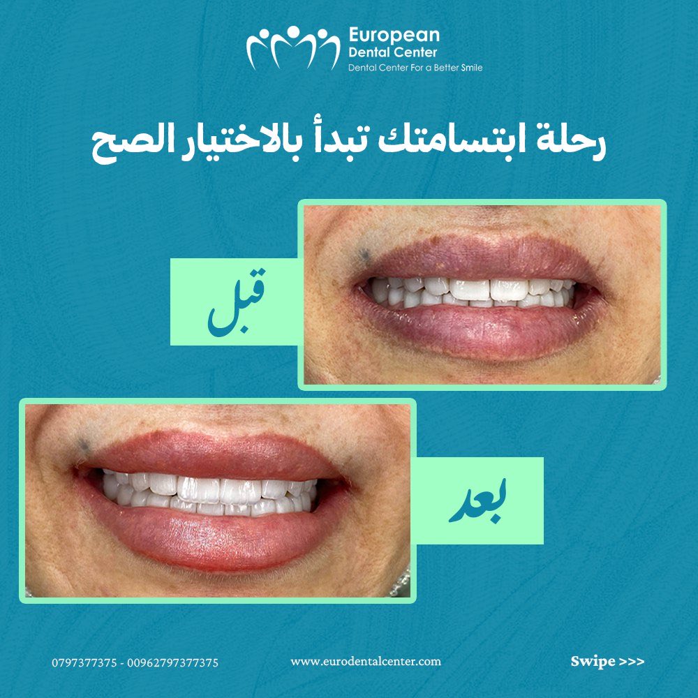 mohanadskiswani's tweet image. &quot;رحلة ابتسامتك تبدأ بالاختيار الصح!&quot;
🤔 كم مرة سمعت ناس ندموا بعد ما اختاروا عيادة “أرخص”؟
الابتسامة مش تجربة مؤقتة… هي قرار مصيري يرافقك كل يوم! 💎
في European Dental Center، نؤمن إن الاختيار الصح هو أول خطوة لابتسامة صحية وجميلة تدوم 🌿
من لحظة دخولك العيادة، بتحس بالفرق:…