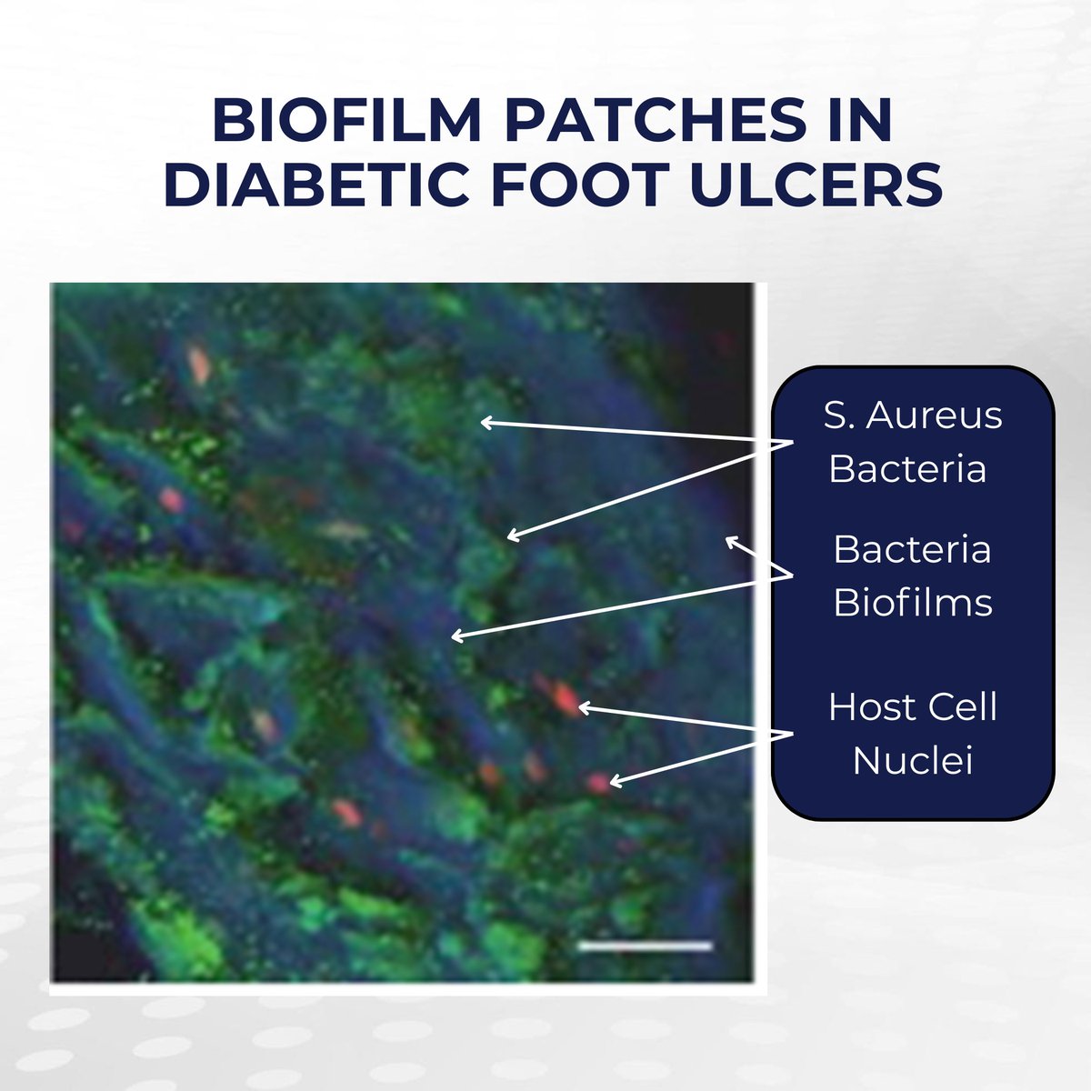 🧫 Why are chronic diabetic foot infections so hard to treat?

Biofilms shield bacteria from antibiotics, &amp; poor blood flow+rising resistance make DFI tough to clear

Utilizing phage to target resilient biofilms offers a potential new option where current treatments fall short🦠