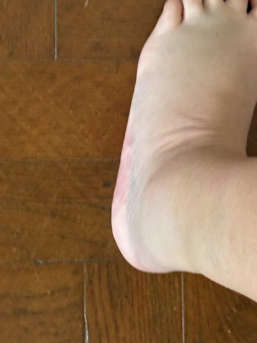 Digiti_Pedis's tweet photo. I've only gone and fractured my little left foot!! All healing vibes appreciated. #littlefeet #feetworshi̇p #footfetish #feet #toes #swollenfoot #bruised https://t.co/8ZlEPZJiJX