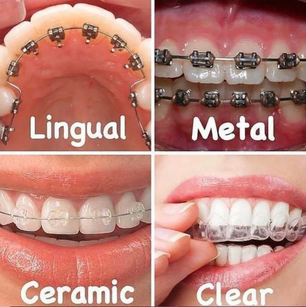 Different types of dental braces 📒📒